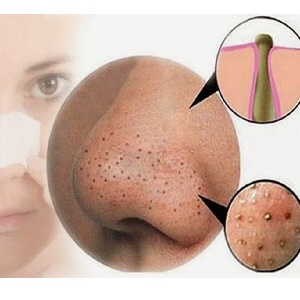         معرفی و درمان 6 نوع جوش صورت