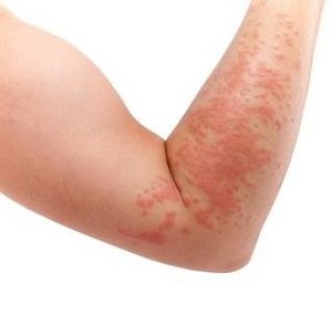 انواع آلرژیهای پوستی را بشناسید